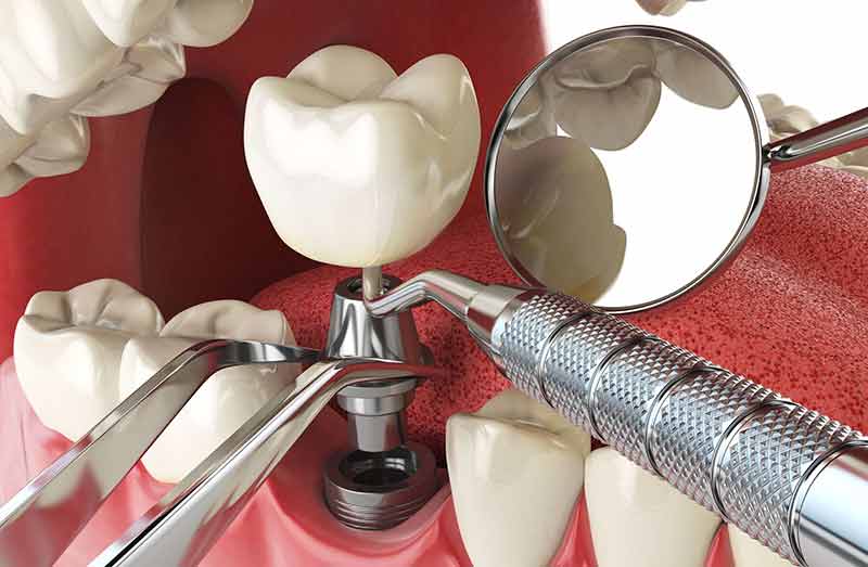 Dental implants